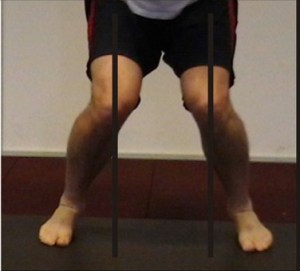 knee-valgus1
